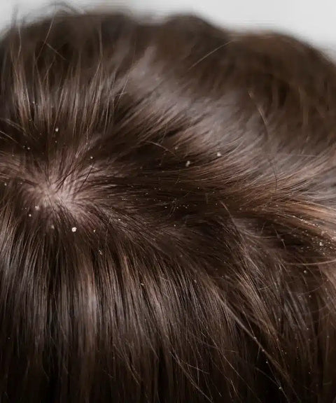 Dandruff